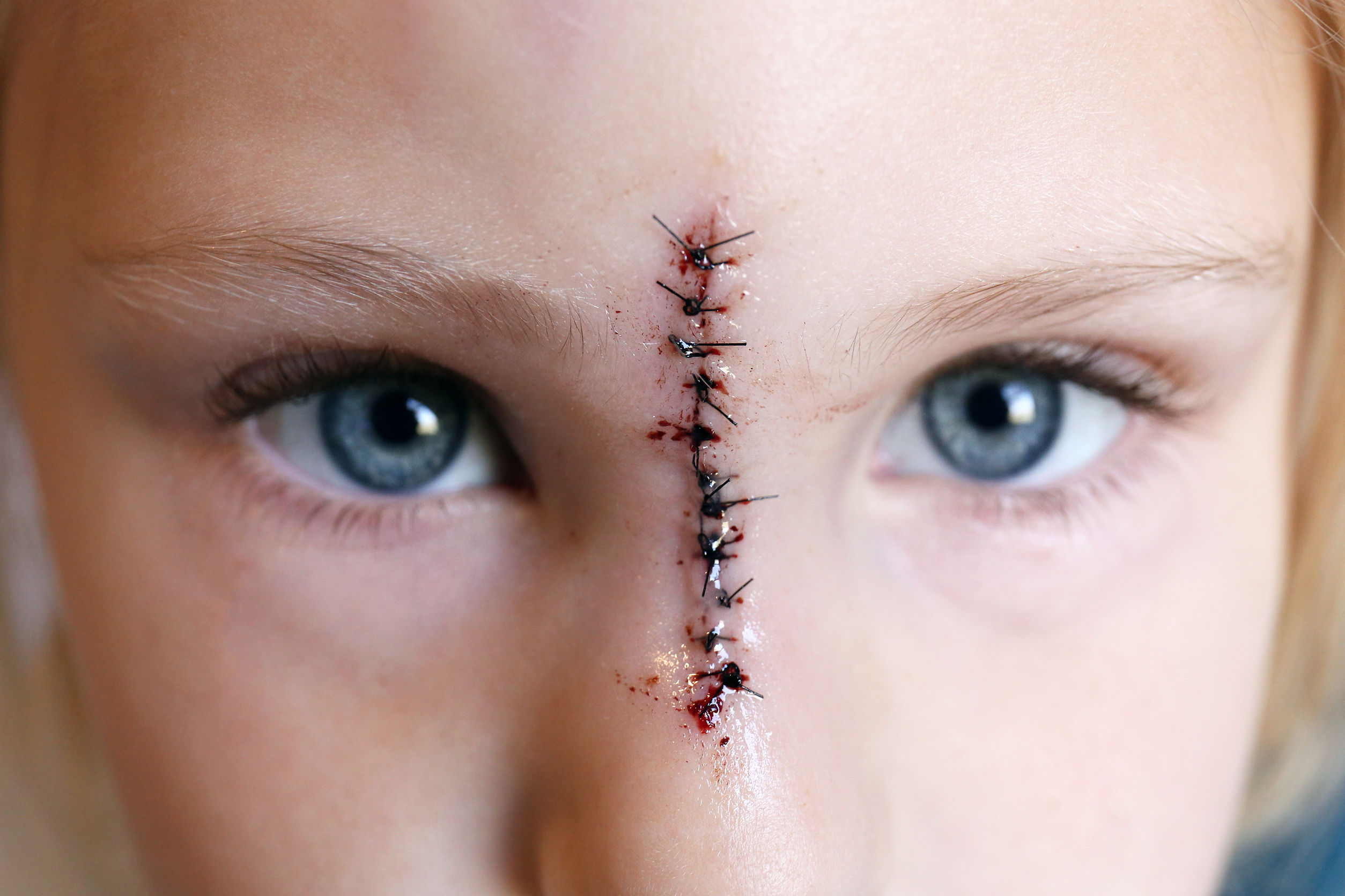 Young Child with Sutures on Face from Injury - Kania Law Office